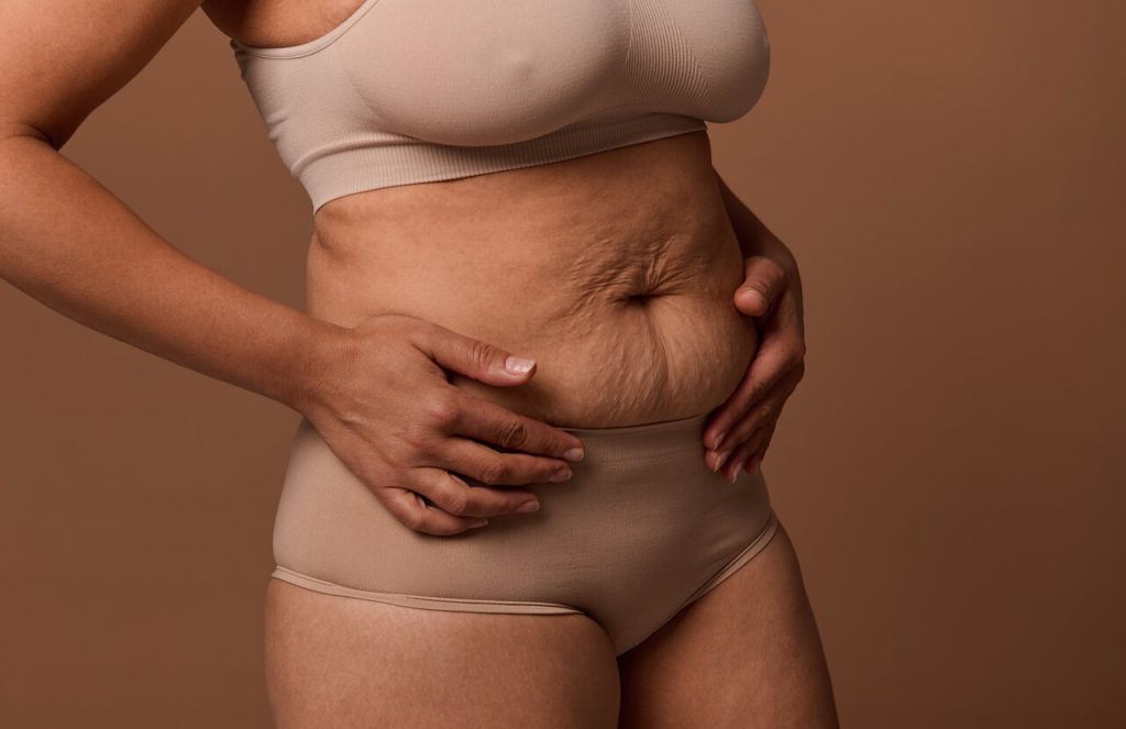 Abdominoplastia