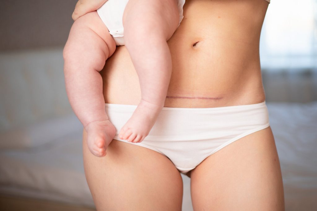 Mommy Makeover