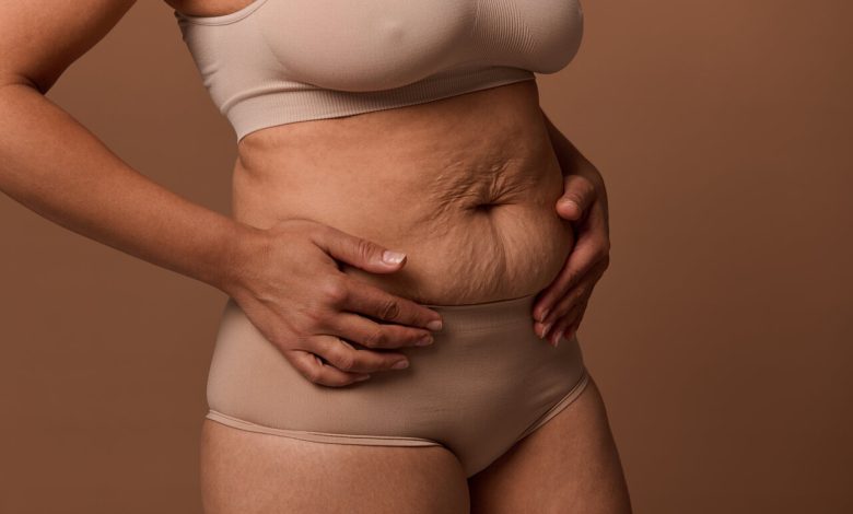 Abdominoplastia