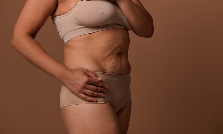 Abdominoplastia e cicatriz o que realmente esperar do resultado
