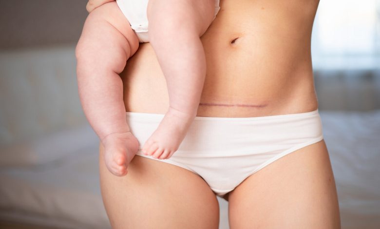 Mommy Makeover